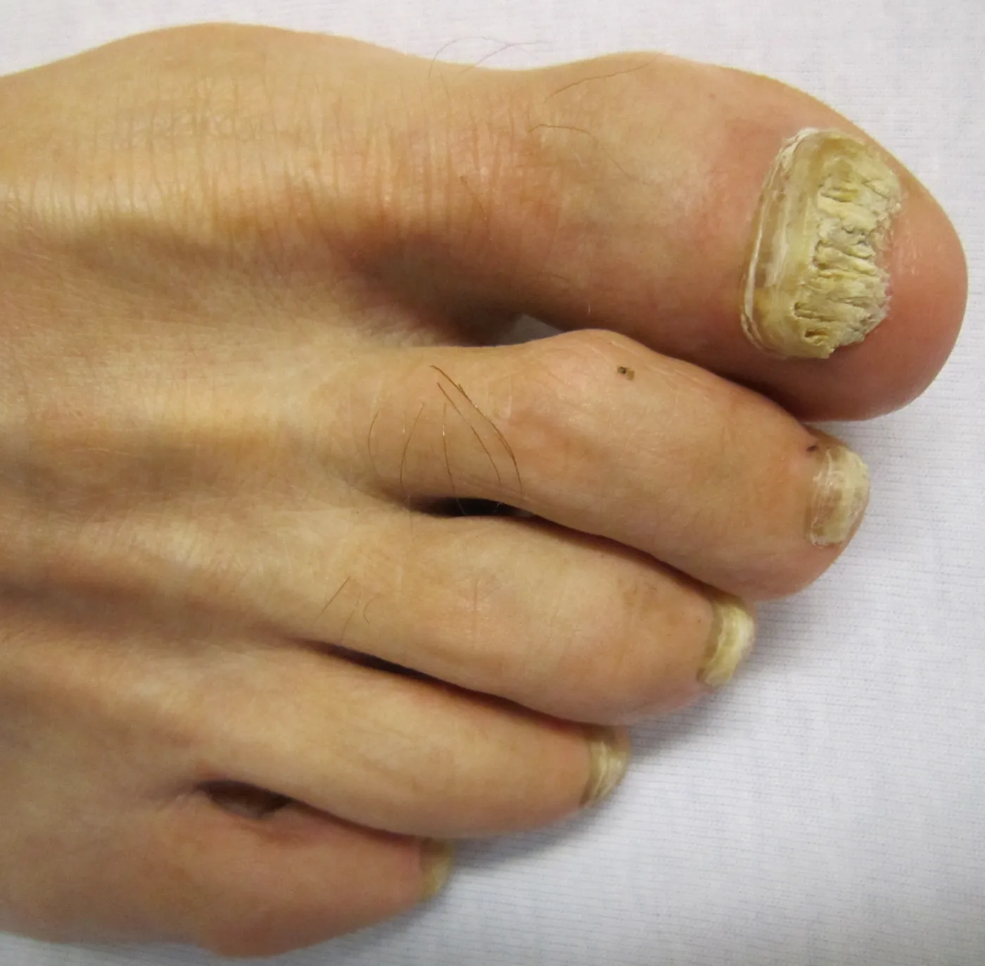 Onicomicosis distrófica total en el primer dedo
